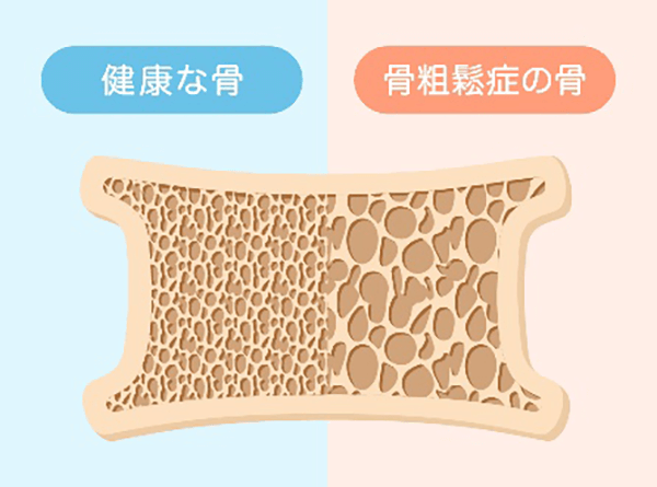 骨粗鬆症(こつそしょうしょう)